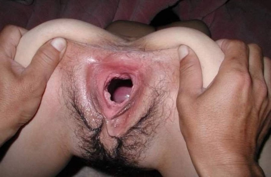 Огромная разорванная вагина