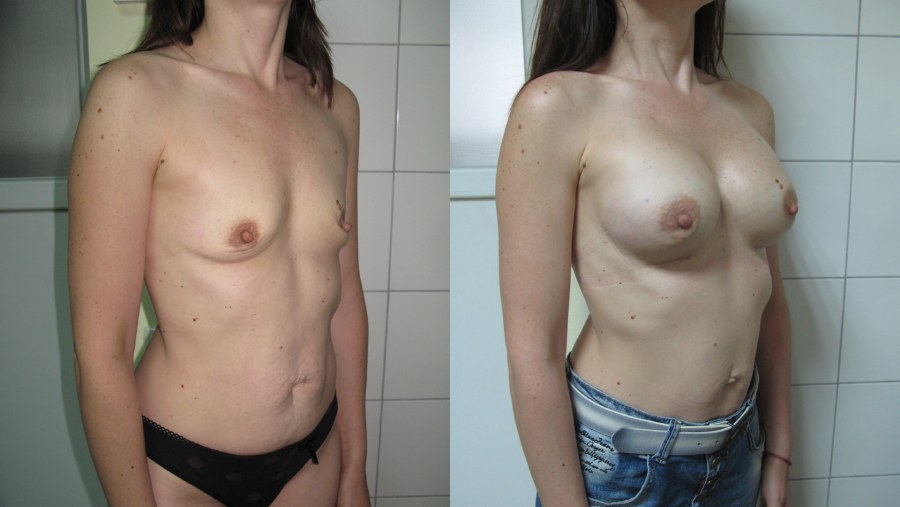 Голая грудь второго размера