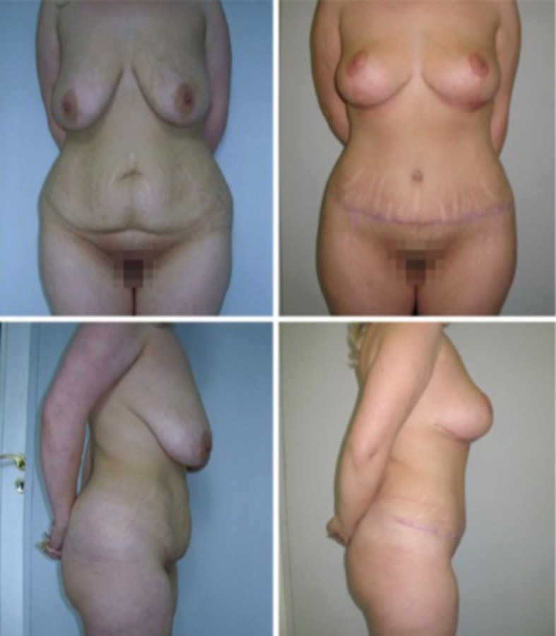 Обвисшая грудь до и после родов