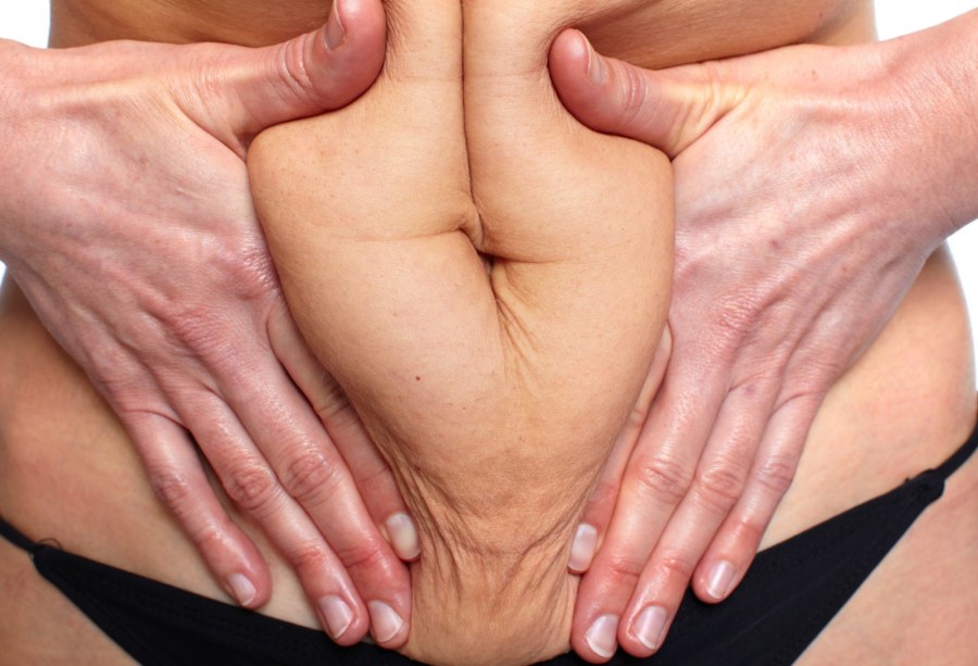 Обвисшая кожа на ногах вектор