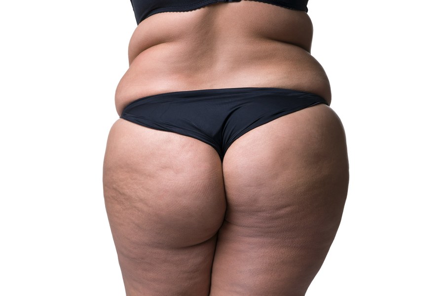 Целлюлитные бедра и ягодицы