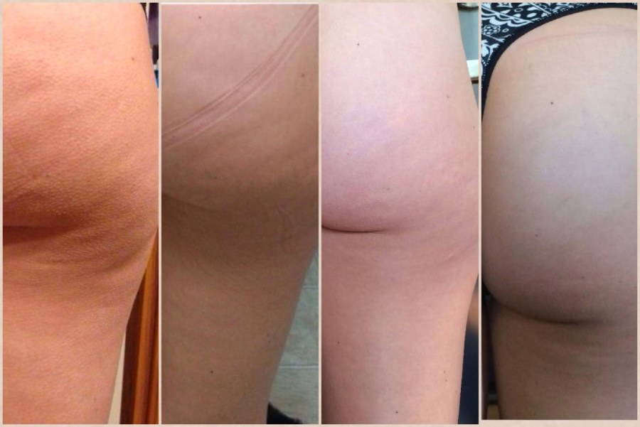 Целлюлит и растяжки на бедрах