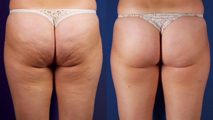 Глютеопластика липофилинг