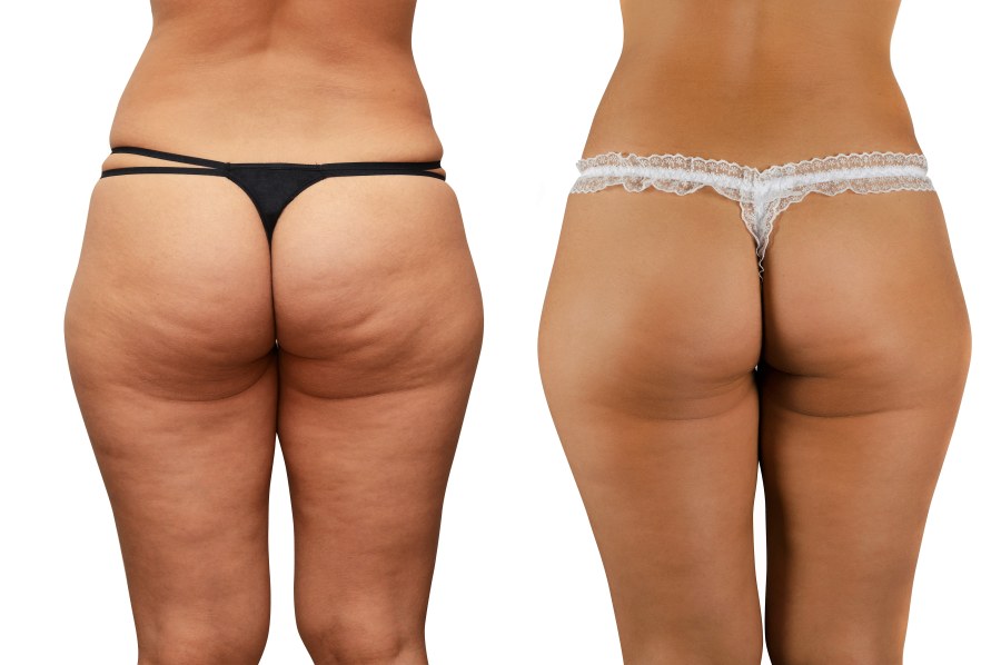 Целлюлит и гиноидная липодистрофия