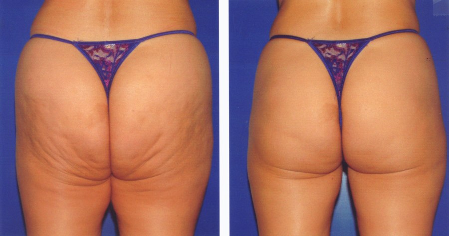 Аппликатор Кузнецова против целлюлита