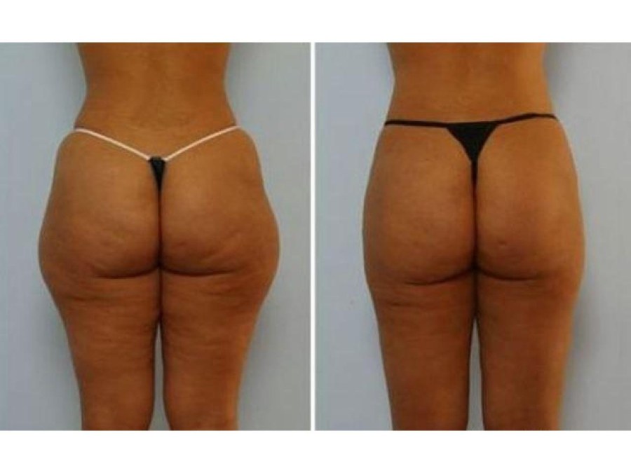 Душ Шарко до и после 10 сеансов