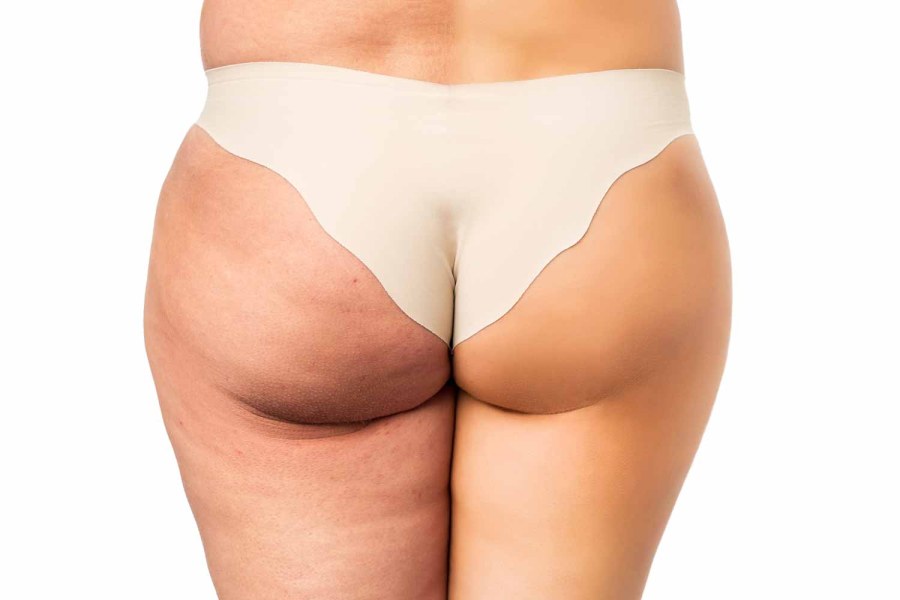 Мужской целлюлит на ягодицах