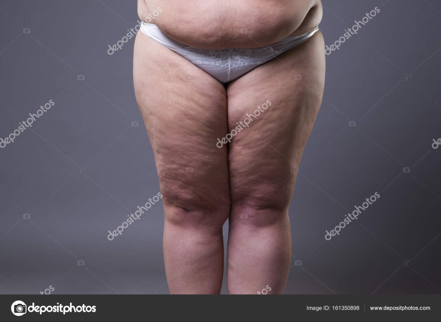 Целлюлитные толстые ноги