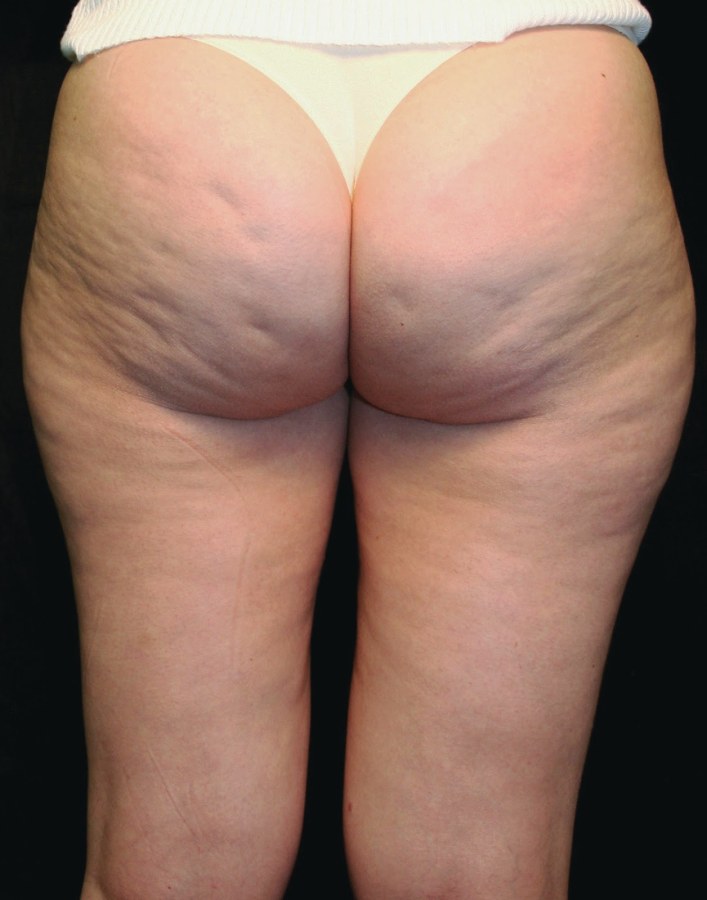 Липодистрофия целлюлит