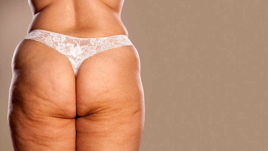 Целлюлит на бедрах и ягодицах