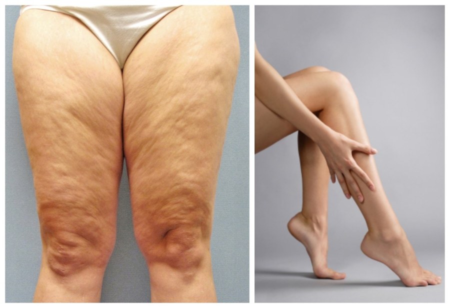 Жир на ляшках