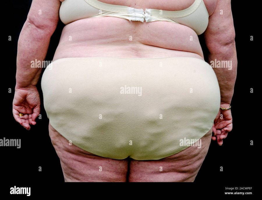 Липодистрофия целлюлит