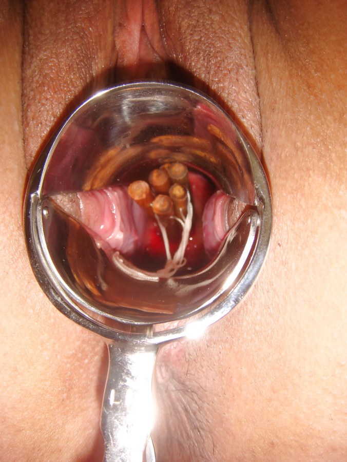 Инородные предметы в матке